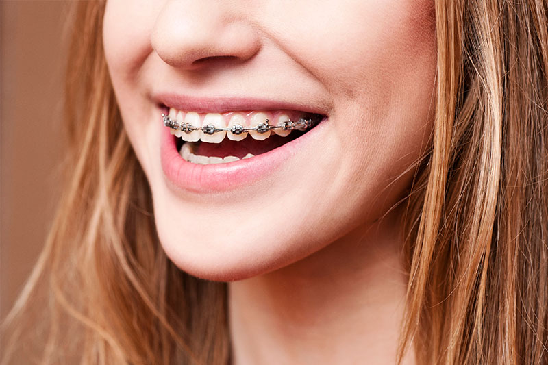 Orthodontics in  San Jose