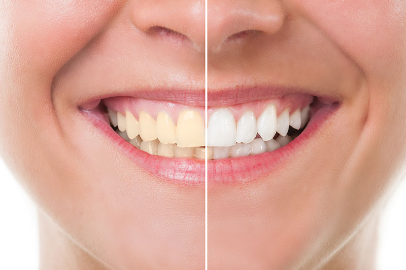 Teeth Whitening in  San Jose